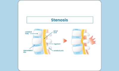 symptoms of the stenosis