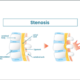 symptoms of the stenosis