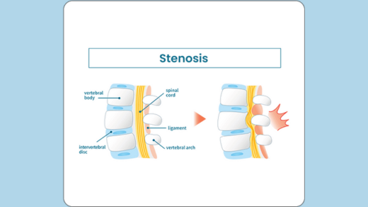 symptoms of the stenosis