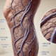 Varicose veins