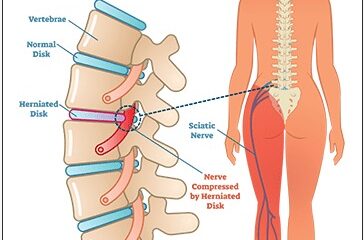 Sciatica Treatment