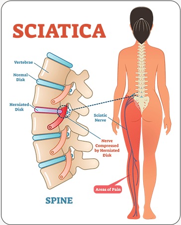 Sciatica Treatment
