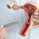 Cervical Cancer Survival Rates
